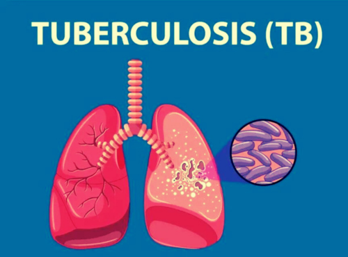 Managing TB requires a combination of medical treatment and a nutritious diet. By focusing on a balanced diet rich in essential nutrients, TB patients can support their recovery and overall health.